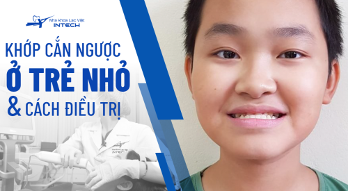 Khớp cắn ngược ở trẻ nhỏ là gì? Bật mí 2 cách chỉnh khớp cắn ngược cho bé