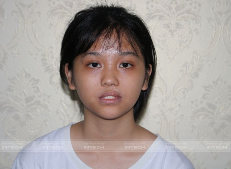 trẻ bị khớp cắn ngược