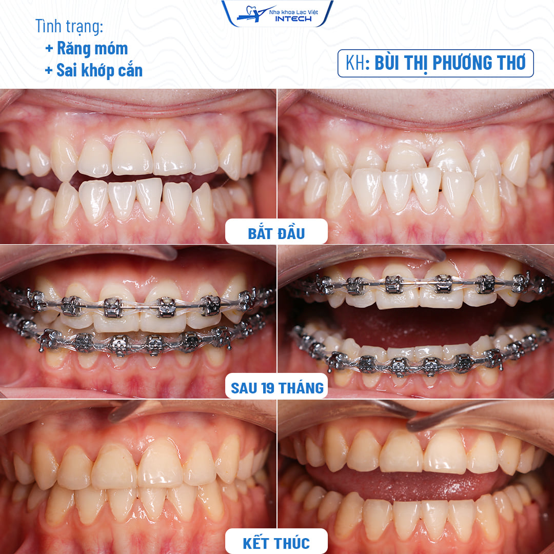 điều trị khớp cắn ngược