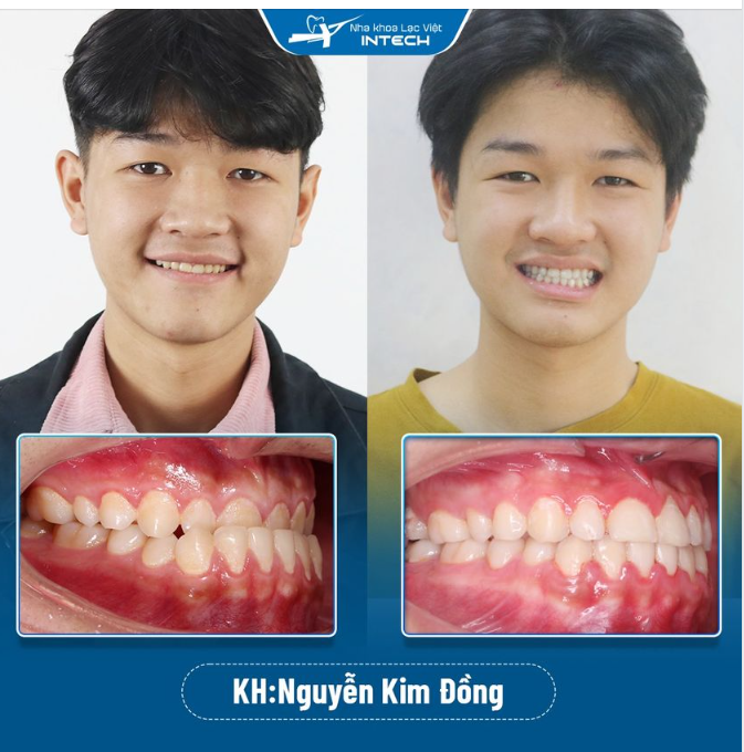 răng cắn ngược