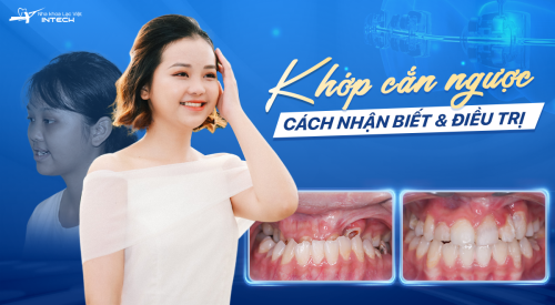 Khớp cắn ngược là gì? 3 Cách điều trị hàm cắn ngược hiệu quả