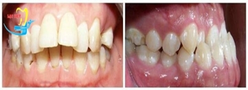 NIỀNG 4 RĂNG CỬA MẤT THỜI GIAN BAO LÂU VÀ GIÁ BAO NHIÊU?