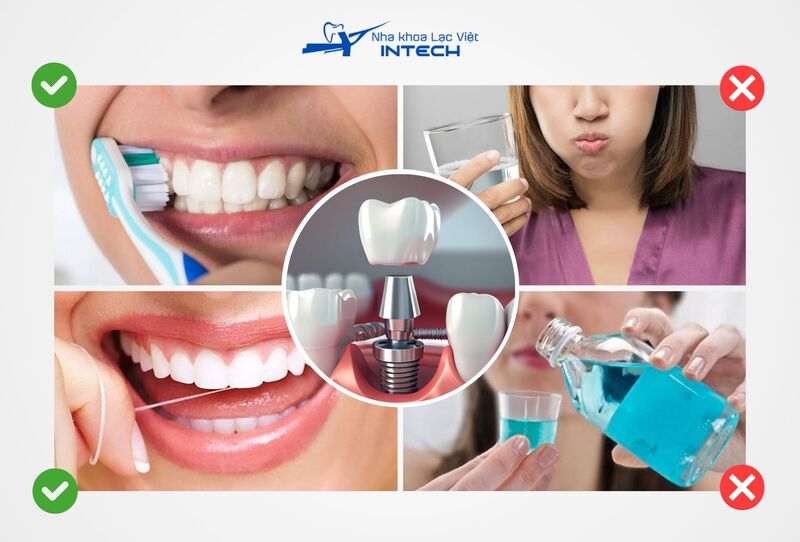 Cô chú/anh chị cần sử dụng bàn chải lông mềm và nhẹ nhàng vệ sinh răng để tránh gây tổn thương lên vùng mới cấy ghép