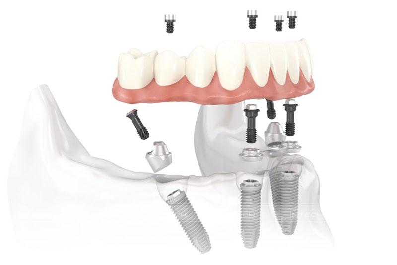 Kỹ thuật trồng răng All-On-4