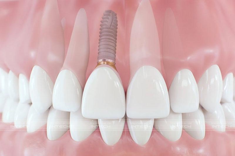 Kỹ thuật trồng răng Implant