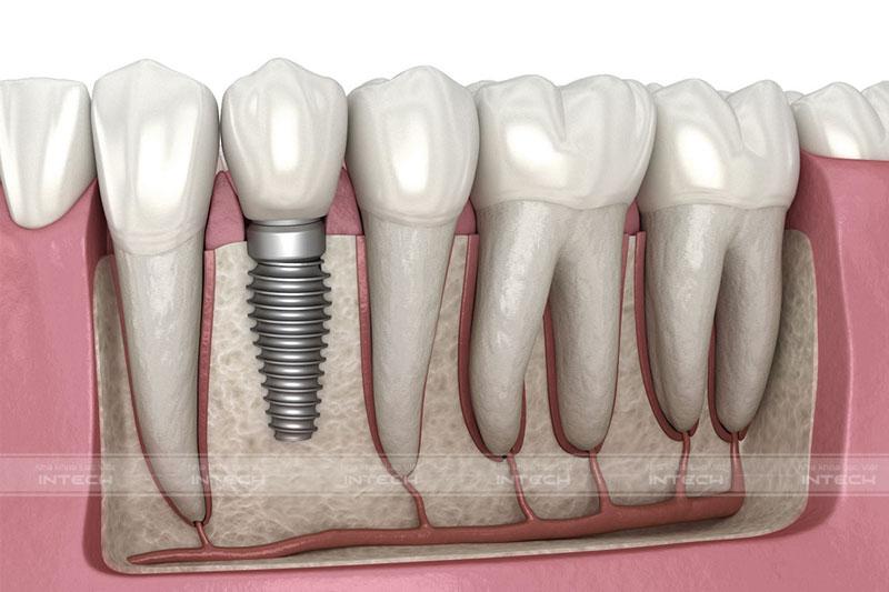 Kỹ thuật trồng răng Implant