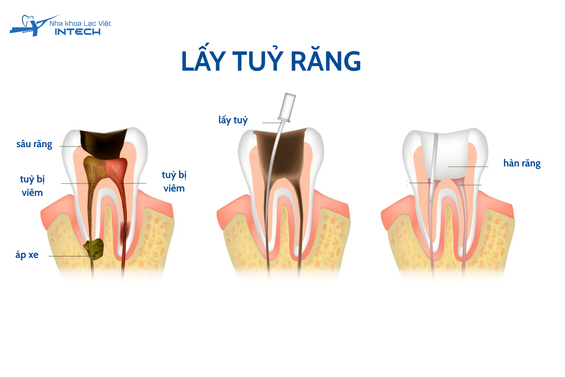 Sâu răng là nguyên nhân phổ biến nhất dẫn tới viêm tuỷ răng phải lấy tuỷ răng