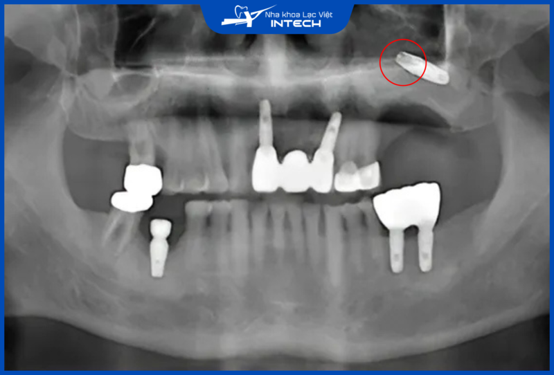 Bác sĩ tay nghề kém có thể xảy ra tình trạng cắm Implant âm phạm xoang hàm trên, gây ra các biến chứng như viêm xoang, đào thải trụ