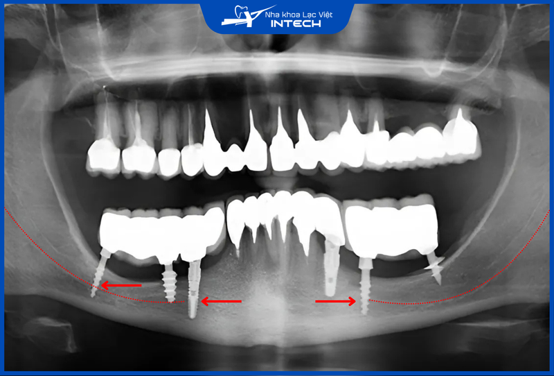 Bác sĩ thiếu kinh nghiệm có thể cắm Implant quá sâu, gây đứt ống thần kinh hàm dưới