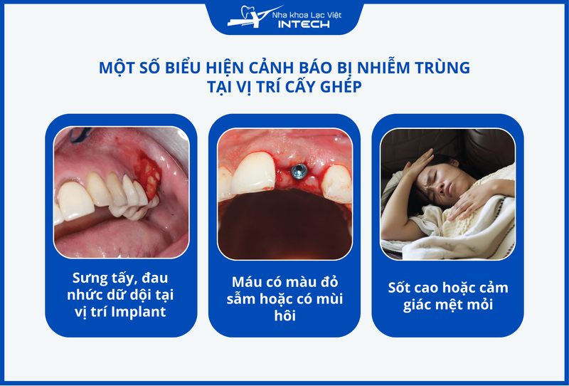 Nếu có các dấu hiệu như sưng đau, chảy máu, sốt cao sau cấy ghép, cô chú/anh chị có thể bị nhiễm trùng và cần đến nha khoa xử lý kịp thời