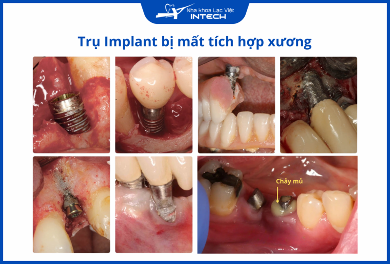 Trụ Implant rẻ tiền thường có nguy cơ mất tích hợp cao hơn, gây ra các biến chứng nghiêm trọng