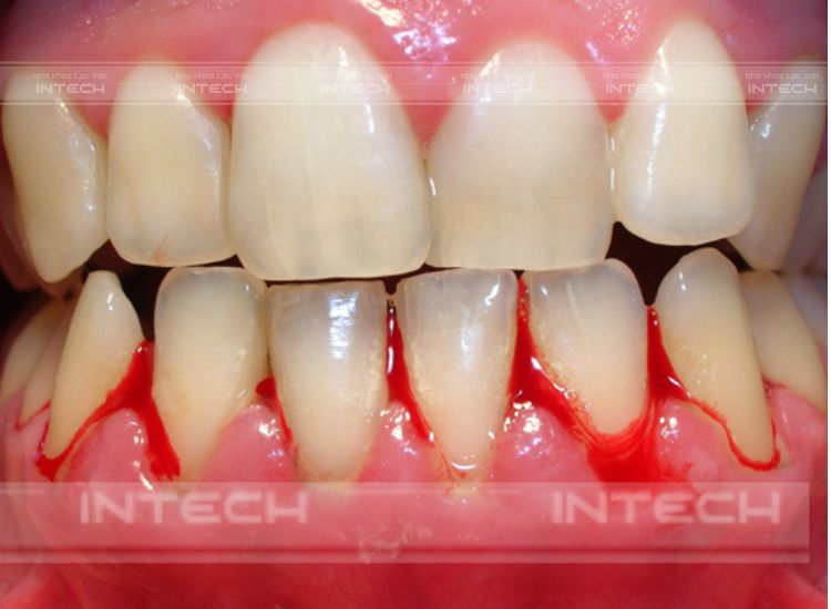 Lợi bắt đầu chảy máu ở giai đoạn sau