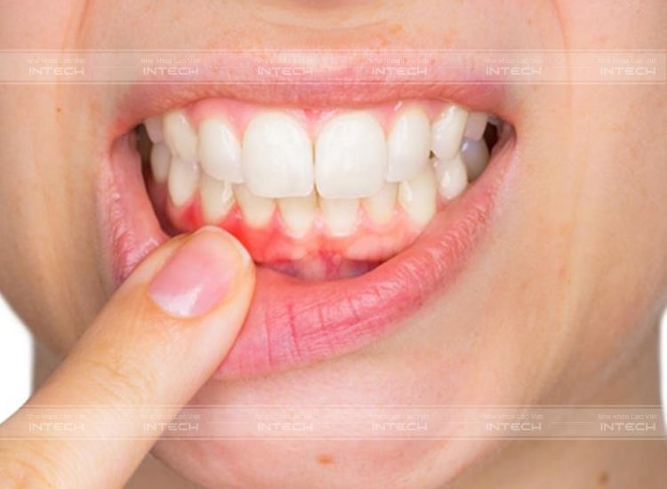 Lợi có triệu chứng sưng phồng