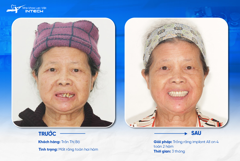 Cô chú/anh chị nên cắm Implant ngay sau khi bị mất răng hoặc có răng bị hư hỏng nặng, cần phải loại bỏ