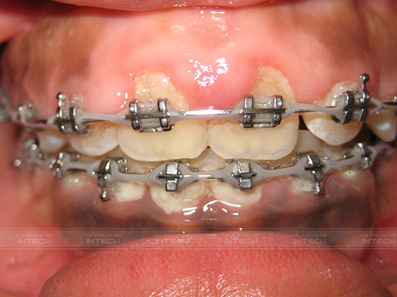 Khi bị lợi trùm, phần lợi sẽ sưng đỏ, tấy, đau nhức thậm chí khi ấn tay vào sẽ thấy rỉ mủ