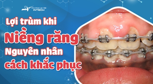 Lợi trùm khi niềng răng: Nguyên nhân, cách phòng ngừa và khắc phục