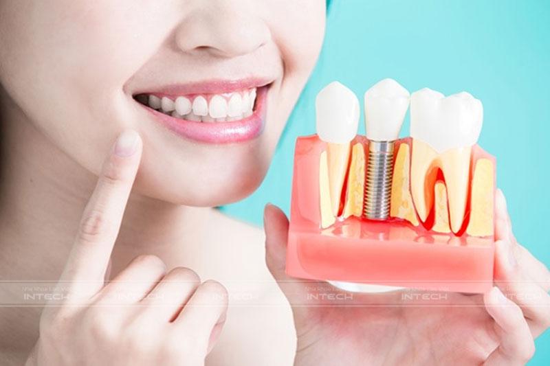 Những lưu ý về quá trình trồng răng Implant sau khi sinh