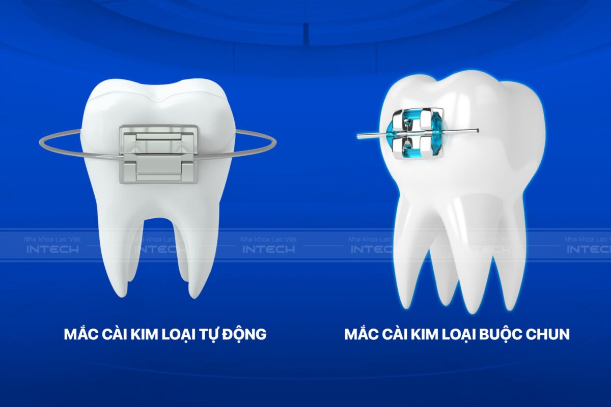 so sánh 2 loại mắc cài tự động và buộc chun