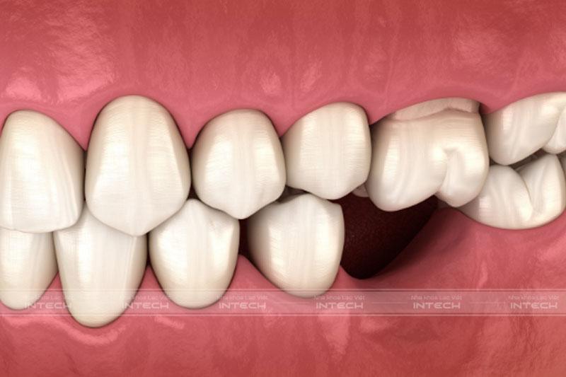 Mất răng số 6 lâu ngày dẫn đến tình trạng tiêu xương, răng đối diện trồi xuống