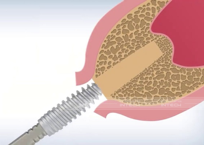 Nâng xoang kín giúp hạn chế xâm lấn ở mức tối đa