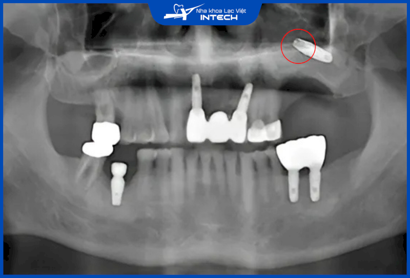 Khi cắm Implant hàm trên, nếu bác sĩ xác định sai độ sâu thì có thể cắm Implant âm phạm xoang hàm, gây nên nhiều biến chứng nguy hiểm