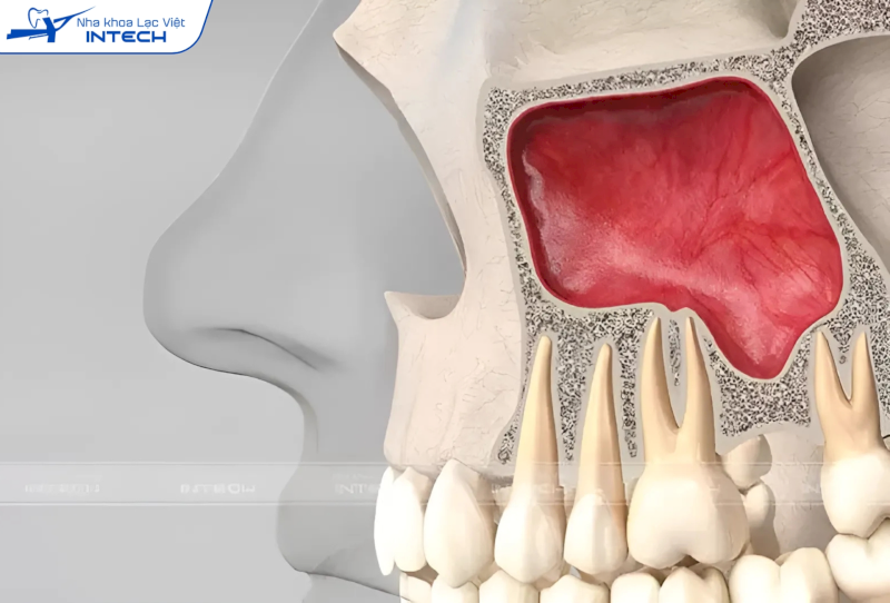 Mất răng khiến khoang xoang sa xuống, dẫn đến thiếu thể tích xương để cấy ghép Implant hàm trên