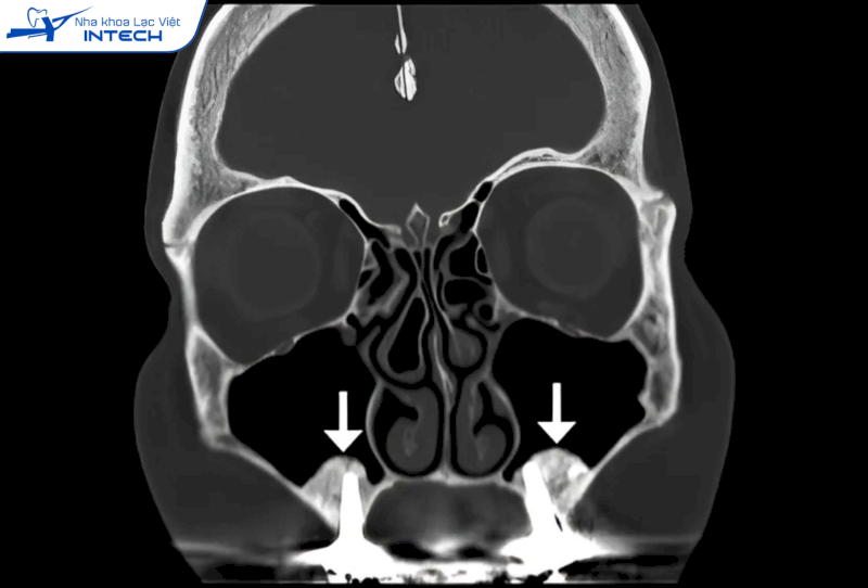 Nâng xoang giúp hàm trên có đủ thể tích xương để đảm bảo trụ Implant được cấy ghép vững chắc