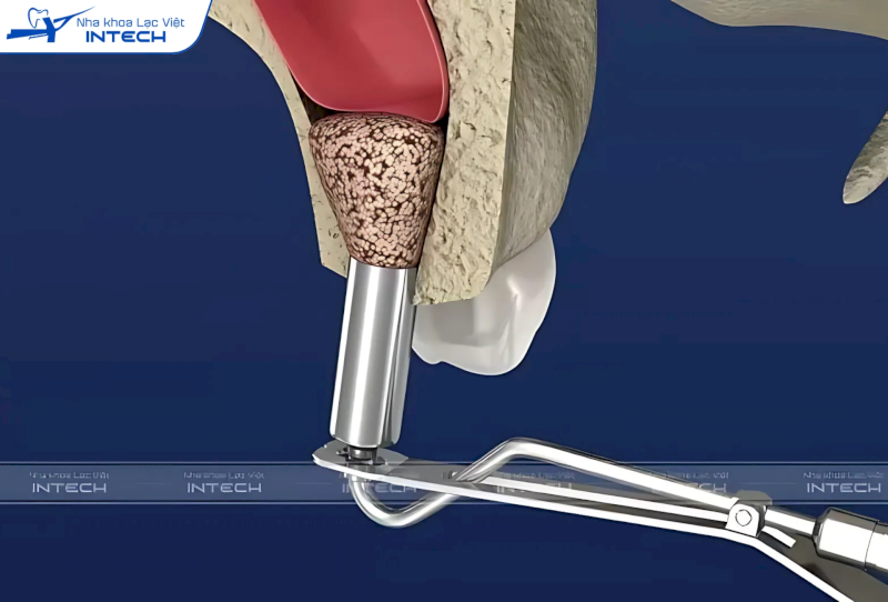 Nâng xoang kín là phương pháp ít xâm lấn, giảm đau đớn và thời gian điều trị