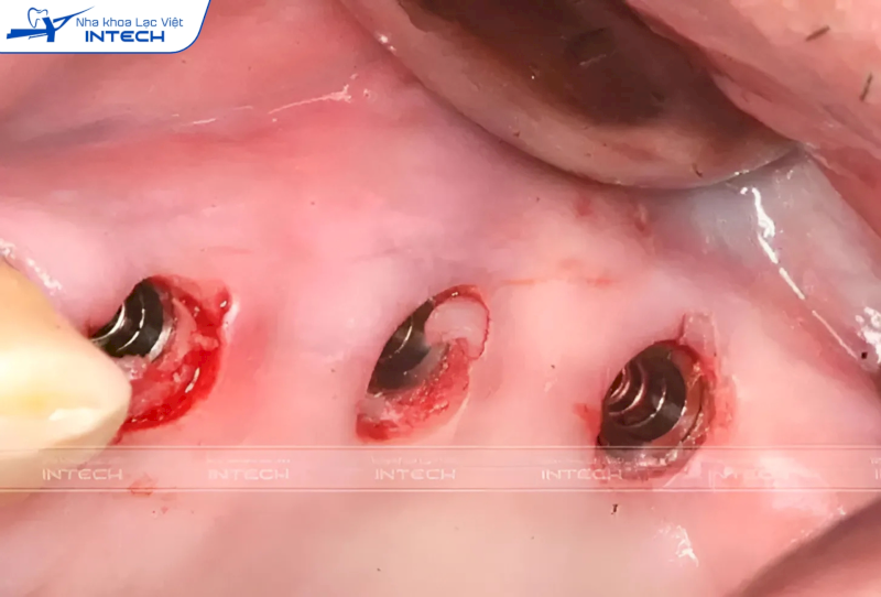 Nâng xoang thủy lực là phương pháp nâng xoang tiên tiến và ít xâm lấn nhất