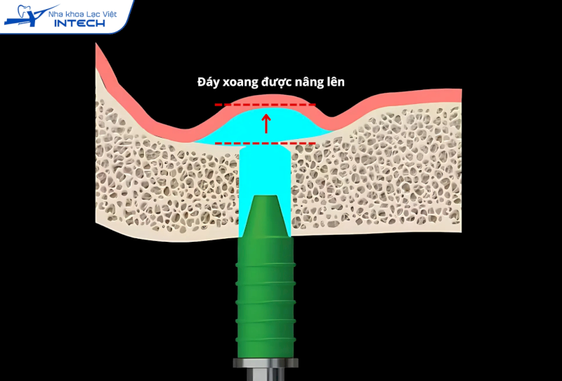 Nâng xoang thủy lực sử dụng áp lực nước để nâng màng xoang nhẹ nhàng, ít xâm lấn
