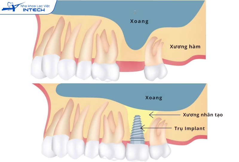 Phương pháp nâng xoang phù hợp với những người cần cắm Implant hàm trên nhưng xoang hàm bị sa xuống quá thấp