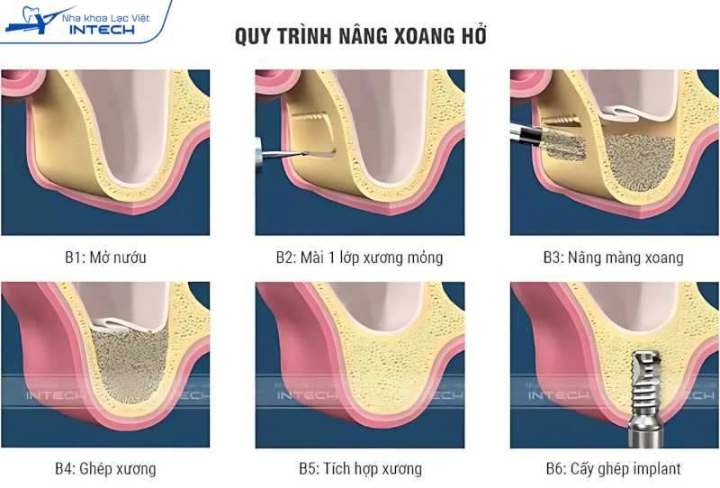 Quy trình nâng xoang hở xâm lấn rộng hơn nâng xoang kín nên thời gian lành thương cũng lâu hơn