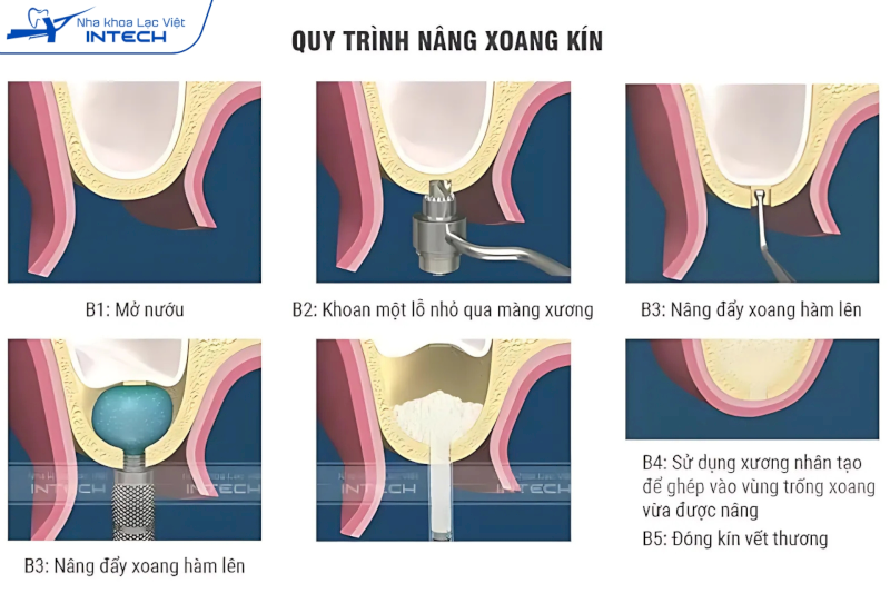 Quy trình thực hiện nâng xoang kín trải qua các bước tỉ mỉ và đòi hỏi tay nghề bác sĩ cao