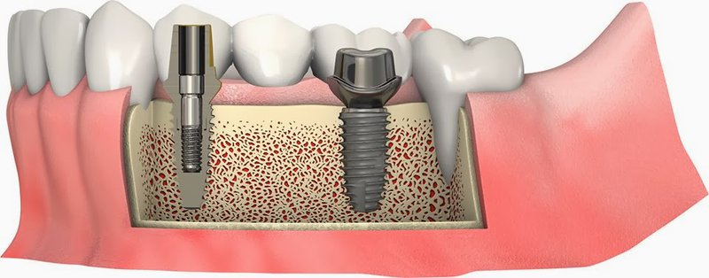 Bác sĩ sẽ chỉ định nâng xoang với một số trường hợp cần thiết