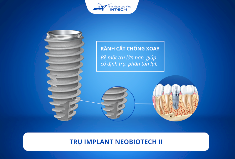 Thiết kế chống xoay giúp trụ Implant chịu lực tốt và ổn định trong xương hàm 