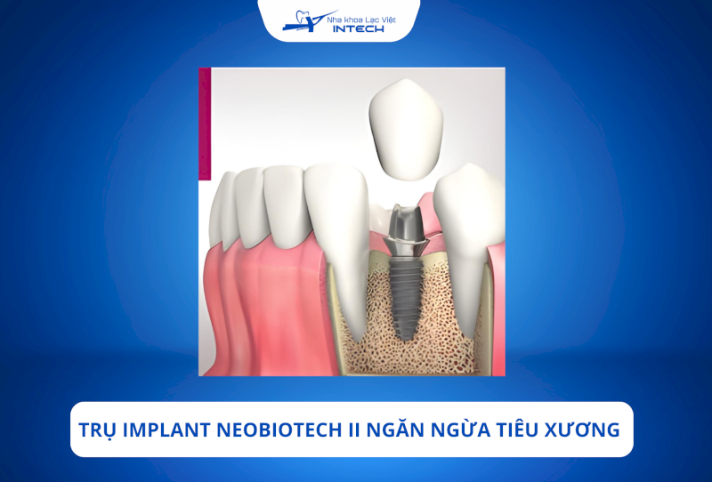 Trụ có thể ngăn ngừa tiêu xương hiệu quả nhờ vào thiết kế giúp Implant bám chắc vào xương hàm