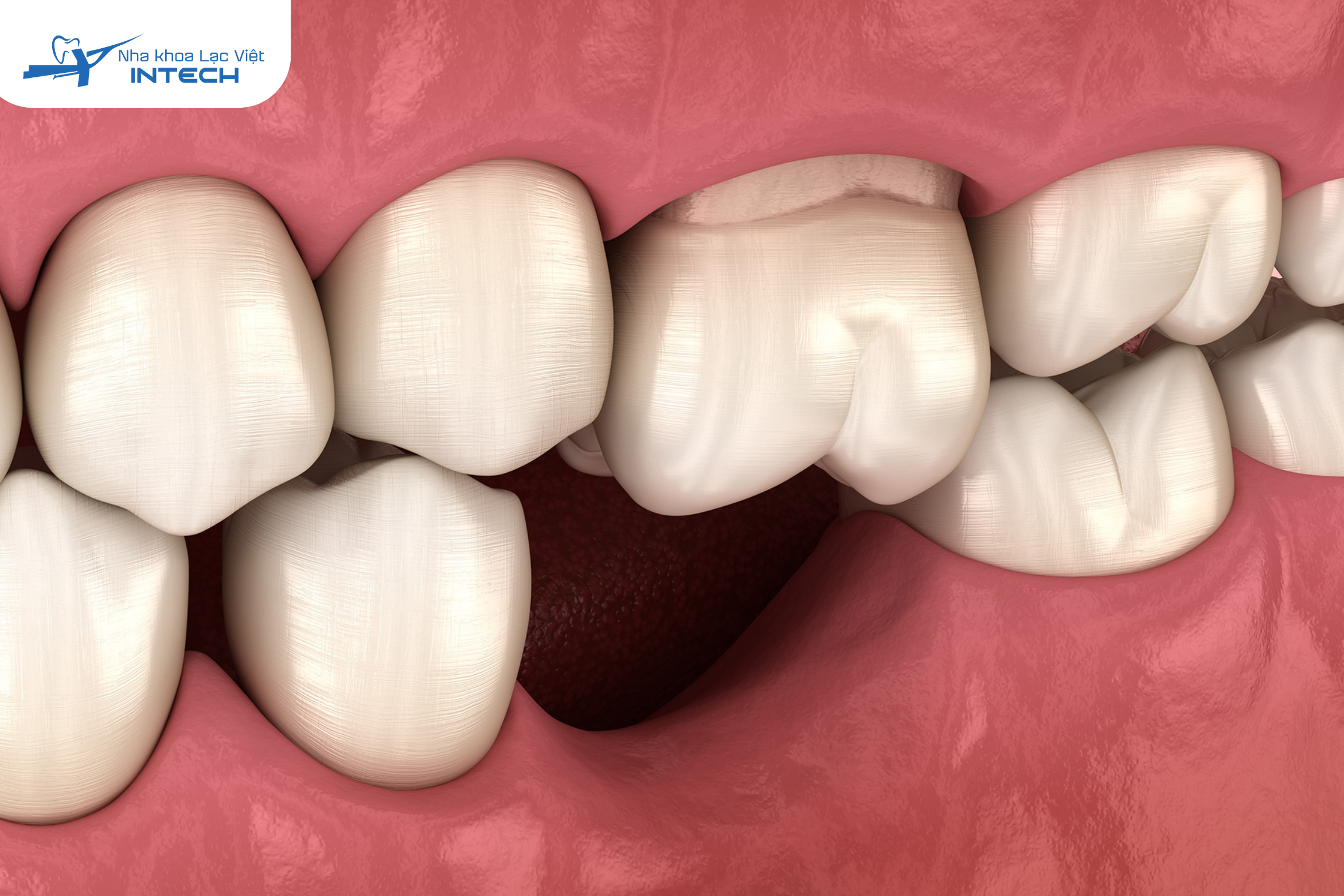 Mất răng 6 có niềng được không 
