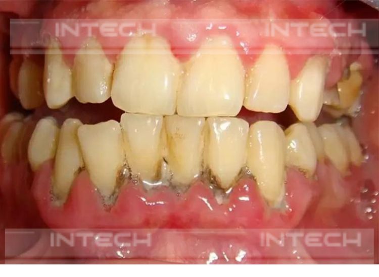 Nguy cơ rụng răng nếu viêm lợi không được điều trị kịp thời