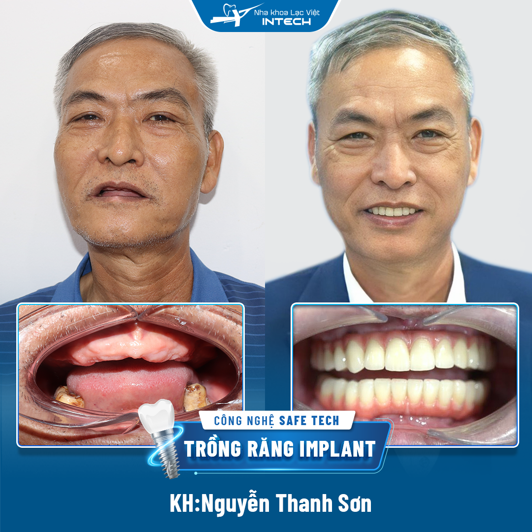 Hình ảnh khách hàng trước và sau khi trồng răng giả nguyên hàm bằng implant tại Lạc Việt Intech
