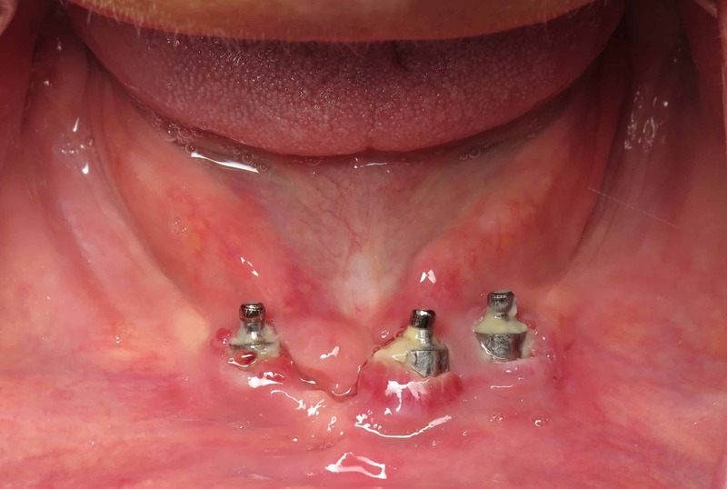 Hình ảnh răng Implant bị nhiễm trùng