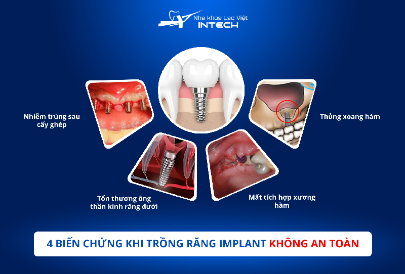 biến chứng khi cấy ghép implant
