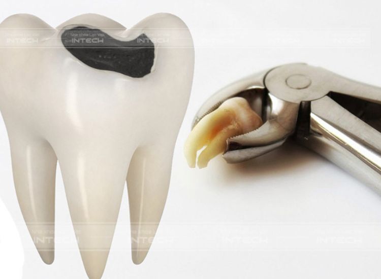 Răng 8 bị sâu nên nhổ bỏ