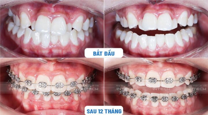 Kết quả khi niềng mắc acif kim loại