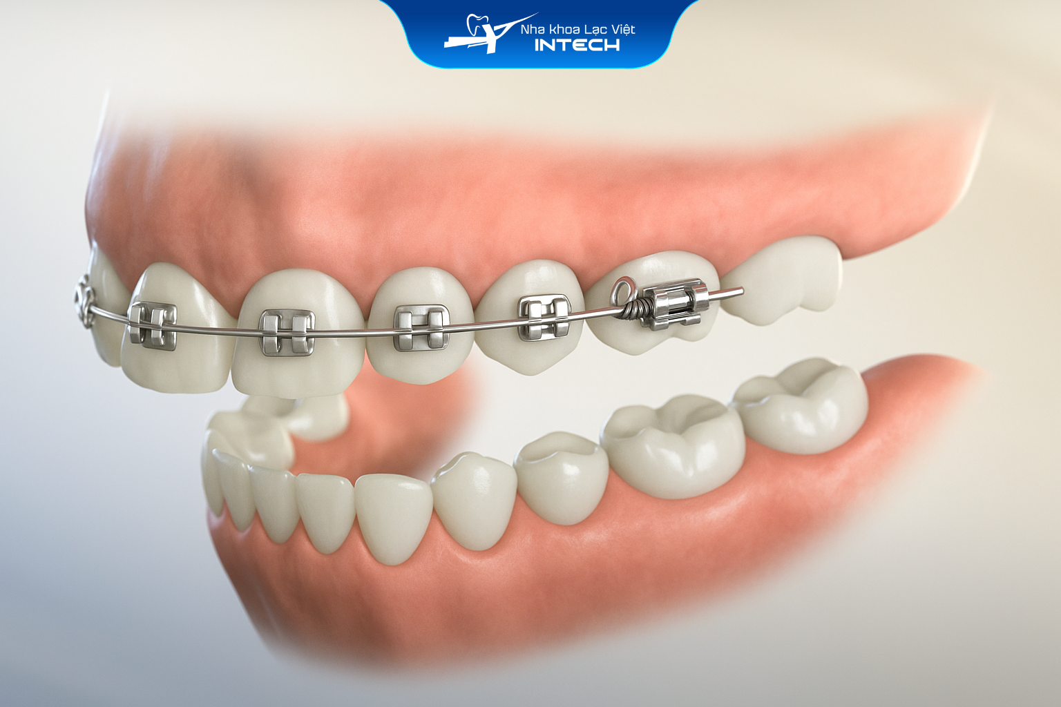 NIỀNG RĂNG 1 HÀM CÓ ĐƯỢC KHÔNG? NHỮNG ĐIỀU CẦN LƯU Ý