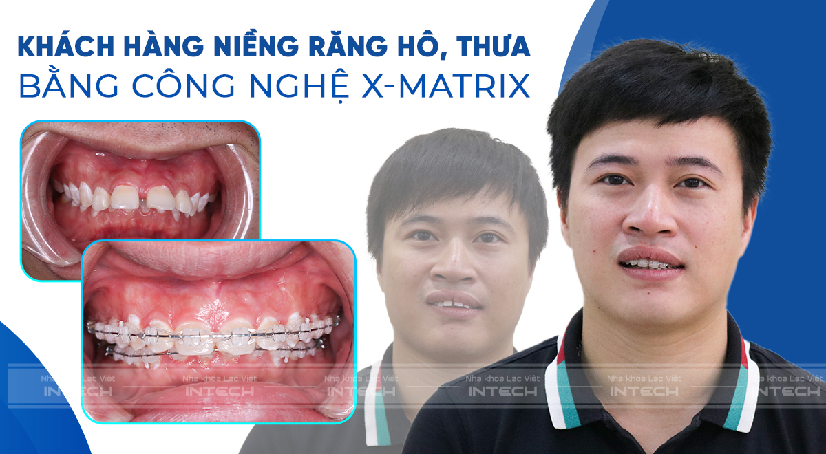 Khách hàng thay đổi ngoạn mục khi niềng răng hô, thưa bằng công nghệ X-Matrix