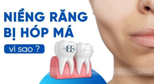 Niềng răng bị hóp má - Nguyên nhân và cách khắc phục