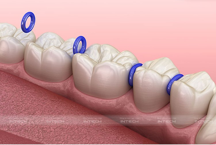 gắn mắc cài có đau không