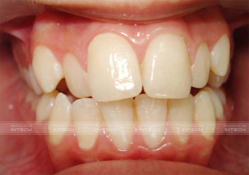 niềng 2 răng cửa