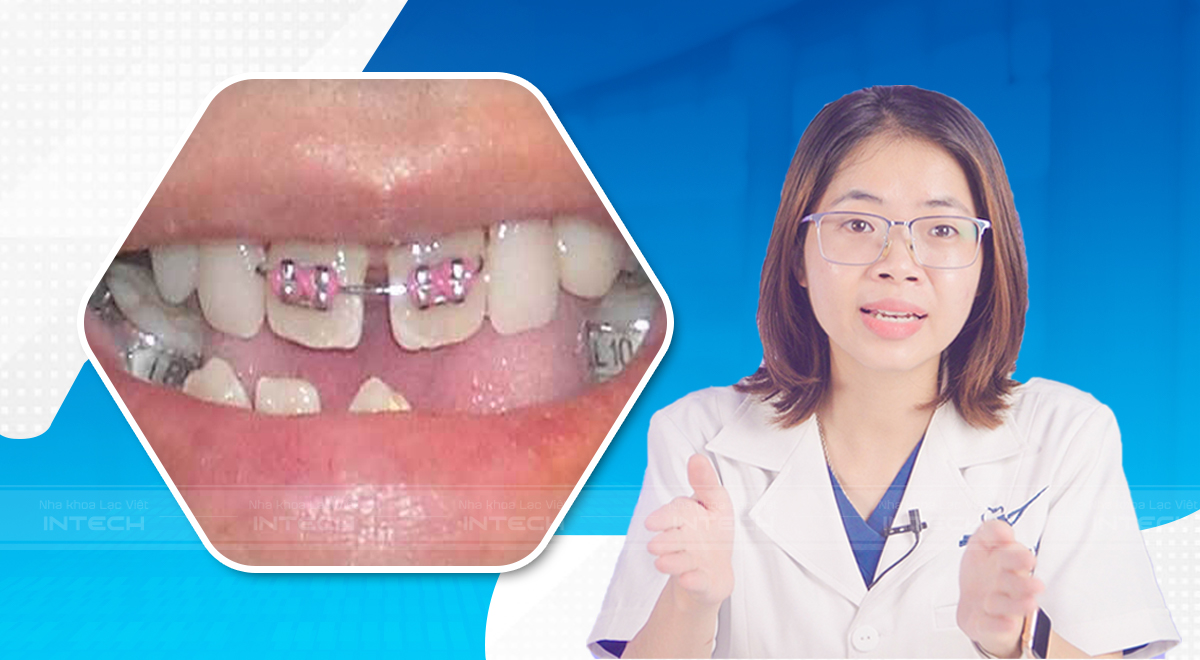 niềng răng cửa thưa
