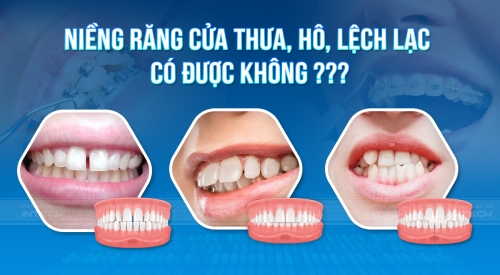 Niềng răng cửa thưa, lệch, hô có được không? Bao nhiêu tiền?